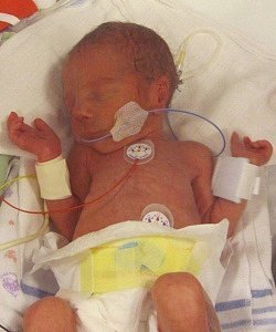 twins born at 33 weeks