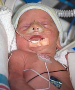 Twin born at 34 weeks